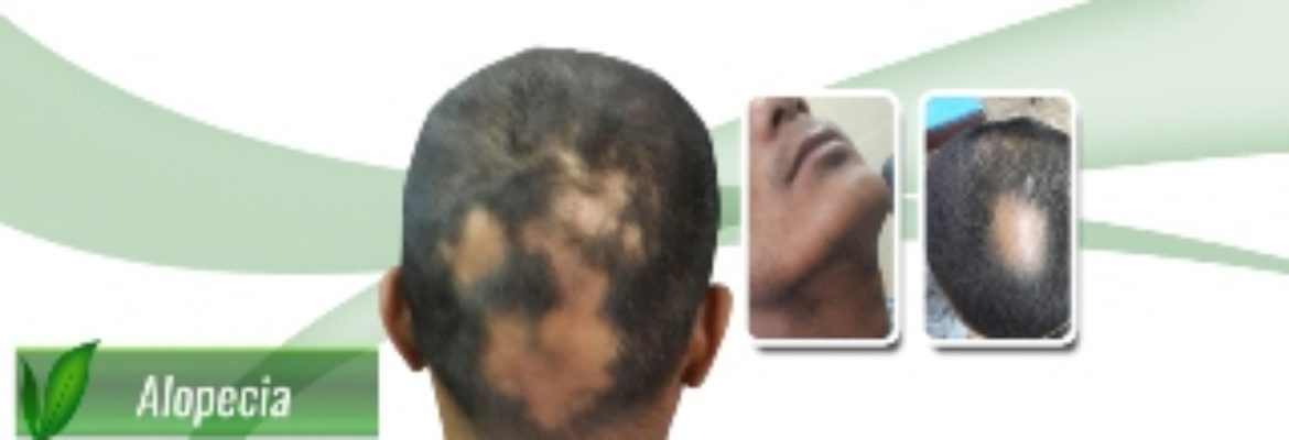 Mokshak Alopecia Ayurvedic Treatment
