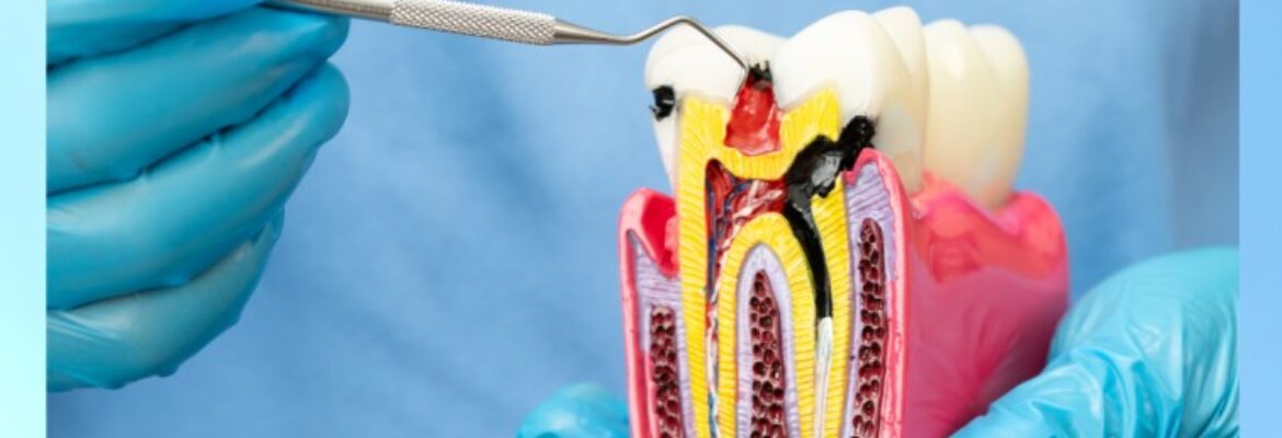 Painless Root Canal Specialist in Hyderabad | Expert Dental Care